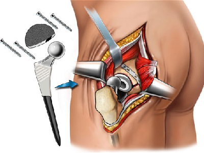 Hip Replacement Surgery In Brazil